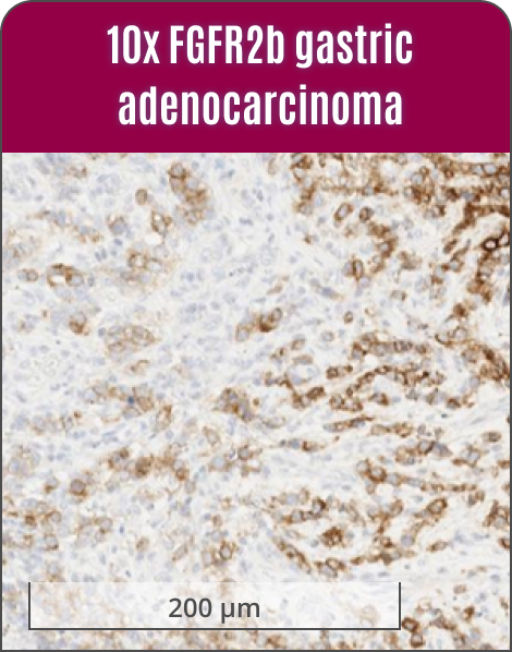 10 fgfr2b gastric adenocarcinoma with partial membrane staining categorized as weak, moderate, and strong