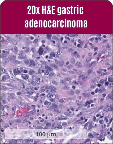 EGE gastric adenocarcinoma, stained with H&E at 20x magnification