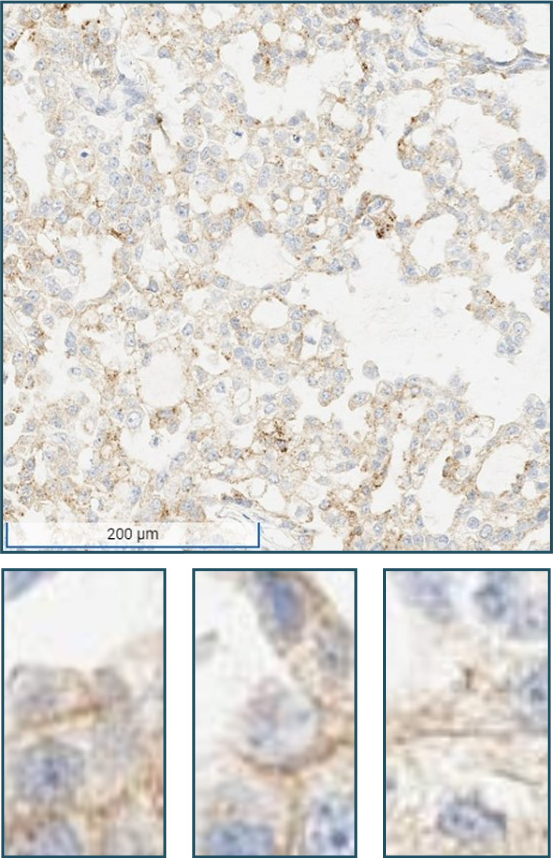 alt="(1+) weak staining FGFR2b protein overexpression evaluation by IHC