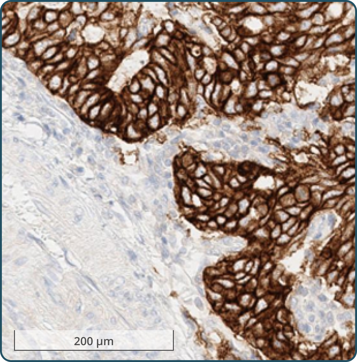 Immunohistochemistry of gastric adenocarcinoma with strong (3+) membranous staining using anti-c-kit antibody