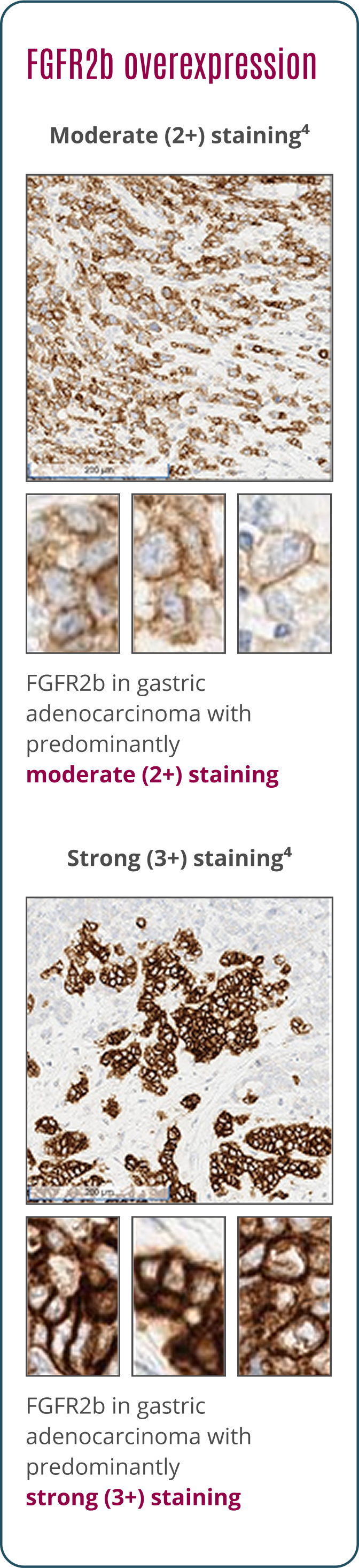 (2+) moderate staining FGFR2b protein overexpression evaluation by IHC | (3+) strong staining FGFR2b protein overexpression evaluation by IHC