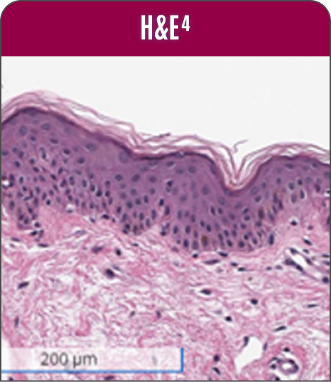 Detailed view of a skin cell with a high concentration of white blood cells, highlighted by H&E staining in non-neoplastic skin