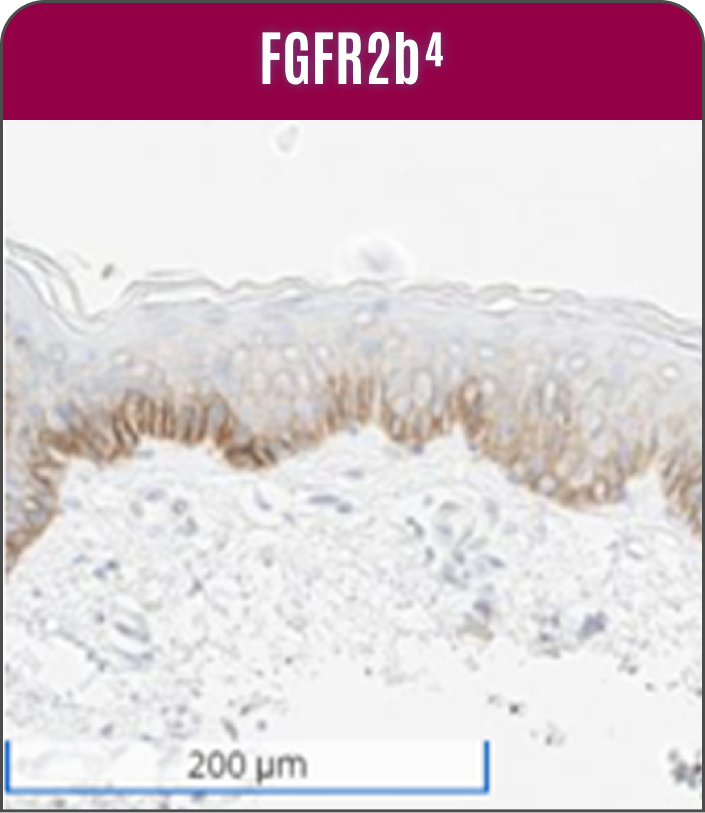 Image of immunohistochemistry results displaying weak to moderate staining of FGFR2b in basal epithelium of non-neoplastic skin.