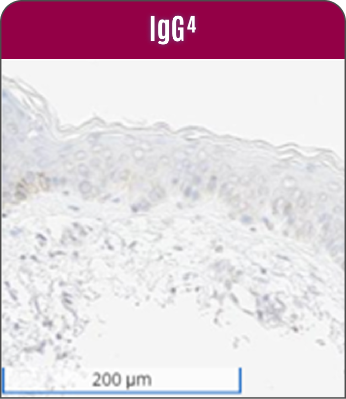 Immunohistochemistry image of non-neoplastic skin, showing IgG negative control with anti-c-jun antibody staining.
