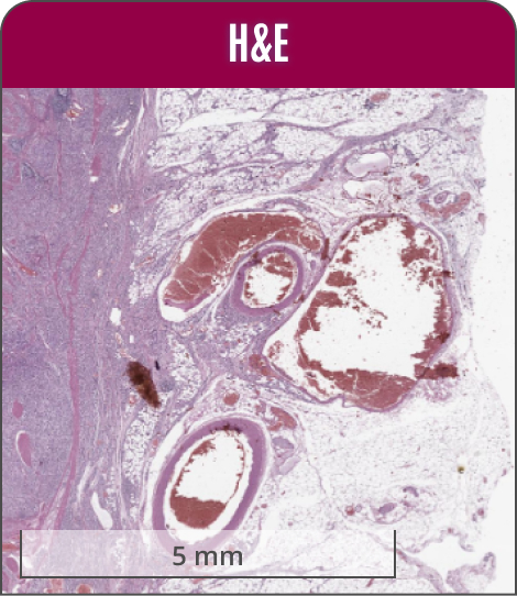 Image of gastric adenocarcinoma showing the presence of a clot in the affected tissue