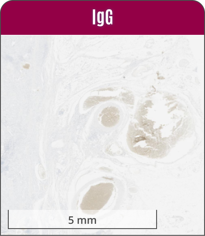 IgG gastric adenocarcinoma with non-specific clot staining" in clear, bold text